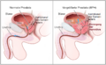 Benign Prostatic Hyperplasia