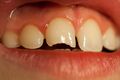 Enamel fracture