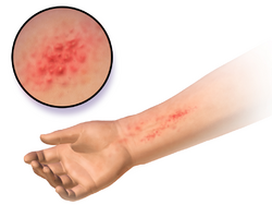 Allergic dermatitis
