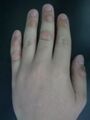 Fingers affected by dermatillomania