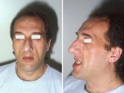 Acromegaly prognathism