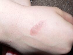 Burn 2nd degree