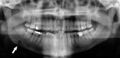 Stafne defect on panoramic radiograph