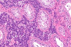 Testicular Cancer Stages