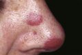 Kaposi's Sarcoma