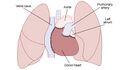 Heart transplant