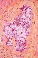 Perineural invasion prostate high magnification