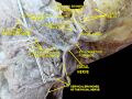 Facial canal