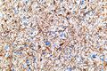Anaplastic Astrocytoma