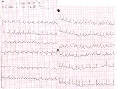 Pulmonary embolism ECG