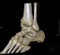 3D CT Reconstruction of Distal Tibia Fracture
