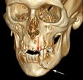 3D CT mandible fracture