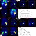 99mTc-MAG3 and 99mTc-DTPA renogram