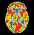 PET scan of a normal brain