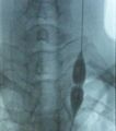 Balloon dilatation procedure for stenosed jugular vein in CCSVI