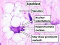 Annotated image of lipoblast features