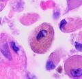 Histopathology of a smoker's macrophage