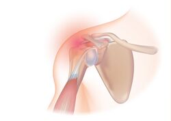 Rotator cuff syndrome