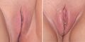 Labia