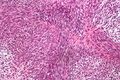 Malignant peripheral nerve sheath tumour - high magnification