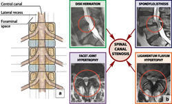 Spinal canal