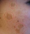 Melasma Blemish