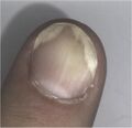 Image showing psoriasis on a fingernail