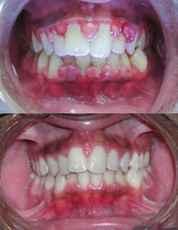 Gingivitis before and after