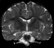 Demyelinating disorder