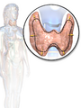 Goiter affecting the trachea.