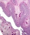 Luteinized follicular cyst