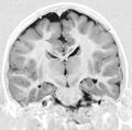 Polymicrogyria with arrows indicating affected areas