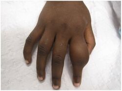 Dactylitis caused by osteoperiostitis due to yaws