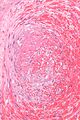 Fetal thrombotic vasculopathy - very high magnification