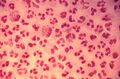 Gonococcal urethritis