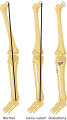 Osteotomy of the tibia