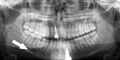 Simple mandible fracture