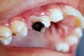 Dental caries cavity