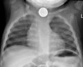 Mediastinal shift