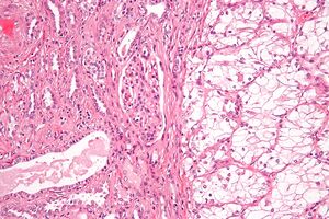 Clear cell renal cell carcinoma high magnification