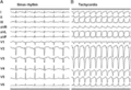 ECG showing accessory pathway in Ebstein's anomaly