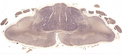 Wallerian degeneration of ALS