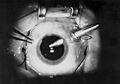Vitrectomy procedure