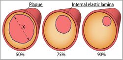 Plaque at different degrees of atherosclerotic stenosis