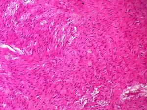 Histopathology of an ovarian fibroma