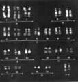 Karyotype isochromosome X