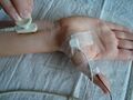 Nerve conduction velocity
