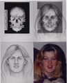 Forensic facial reconstruction