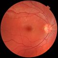Retina