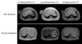 MRI Liver steatosis